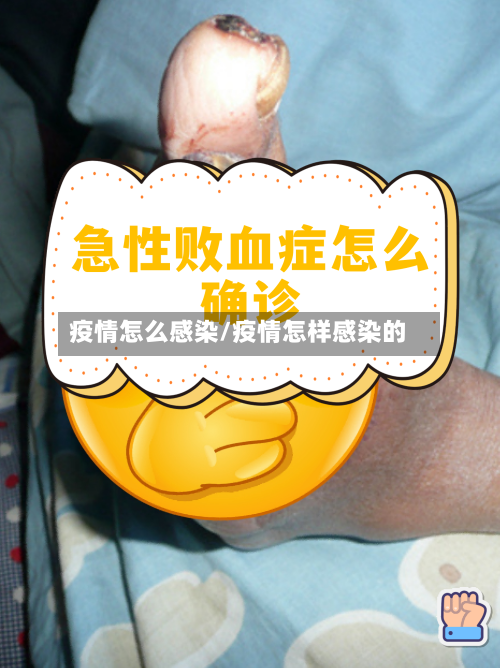 疫情怎么感染/疫情怎样感染的