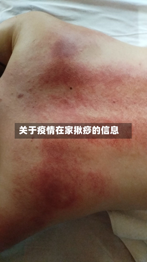 关于疫情在家揪痧的信息