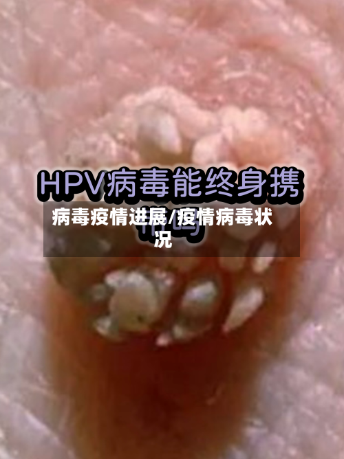 病毒疫情进展/疫情病毒状况