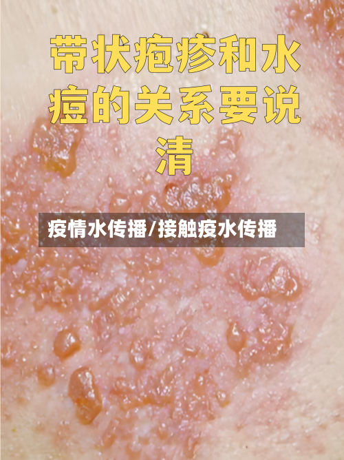 疫情水传播/接触疫水传播-第2张图片