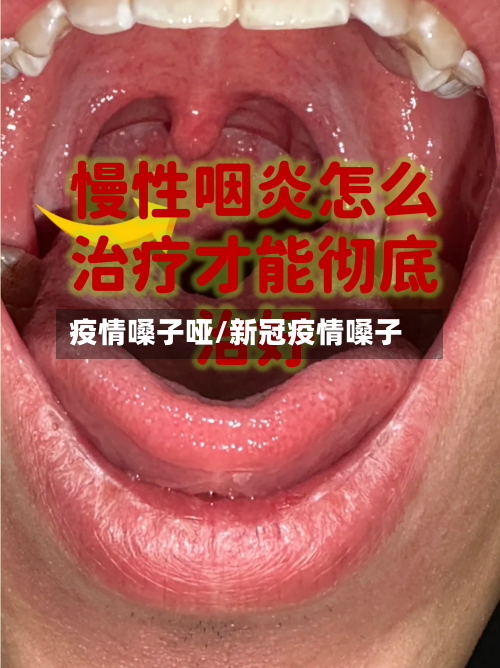 疫情嗓子哑/新冠疫情嗓子-第2张图片